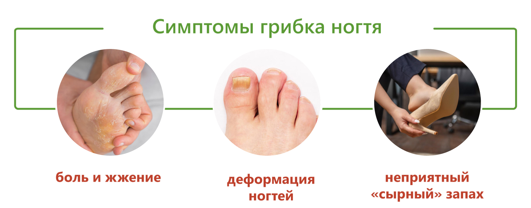 Симптомы грибка ног