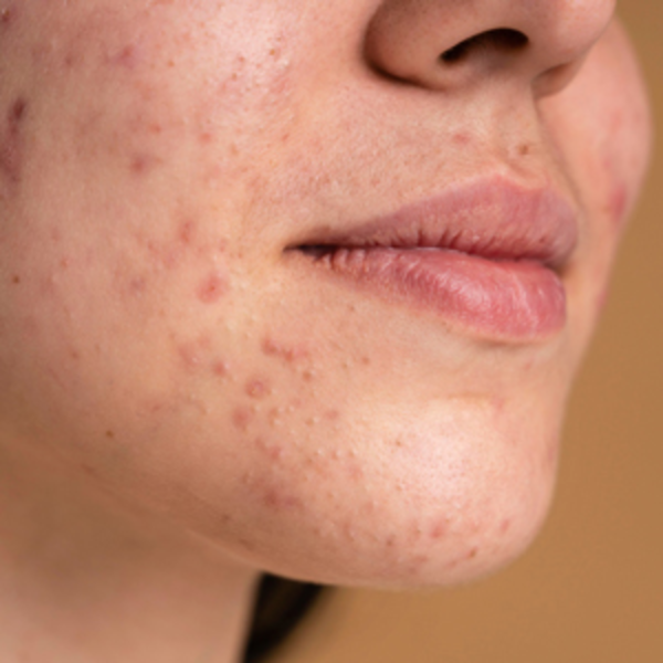 Раздражение кожи:  причины и лечение